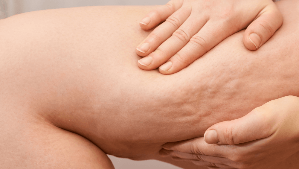 How to Reduce Cellulite on Legs and Buttocks with Ocarine®